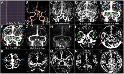 Evaluating the Velocity and Extent of Cortical Venous Filling in Patients With Severe Middle Cerebral Artery Stenosis or Occlusion